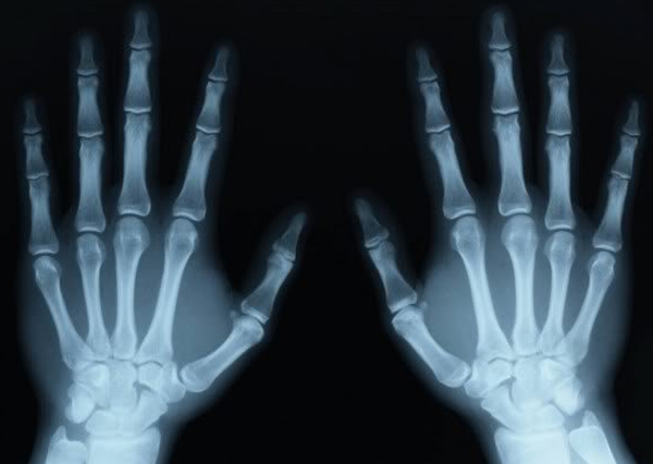 Chụp X-quang cho hình ảnh giúp chẩn đoán các bệnh viêm khớp